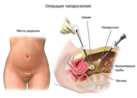 Операция лапароскопии по удалению кисты на яичнике: кому показано и как проходит