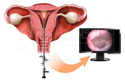 Гистероскопия месячные беременность.jpg