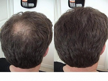 Бесшовный метод пересадки волос: доступно только в ДНК КЛИНИКЕ